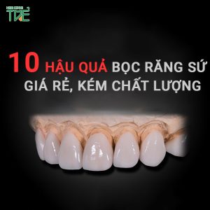 10 hậu quả bọc răng sứ giá rẻ không phải ai cũng biết