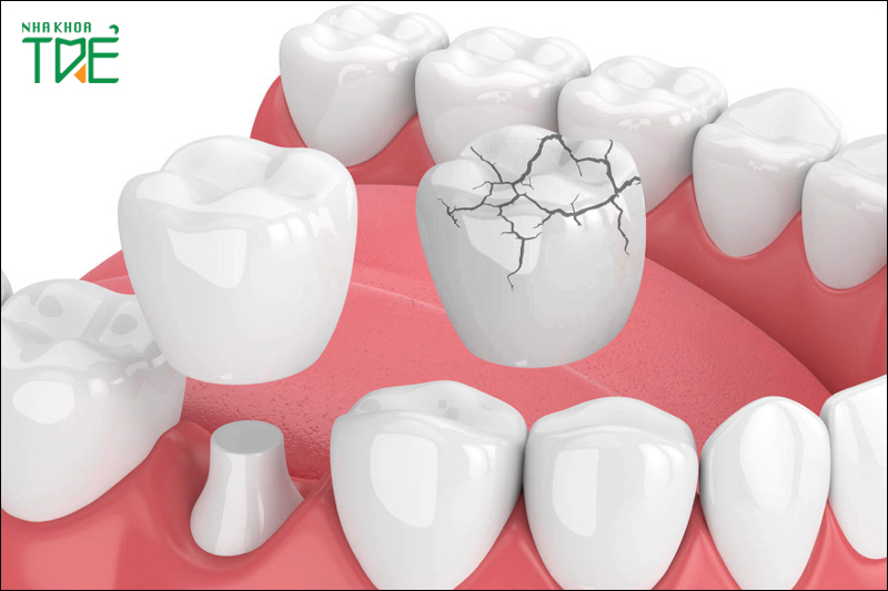 Răng sứ kém chất lượng sẽ bị vỡ nứt sau một thời gian sử dụng