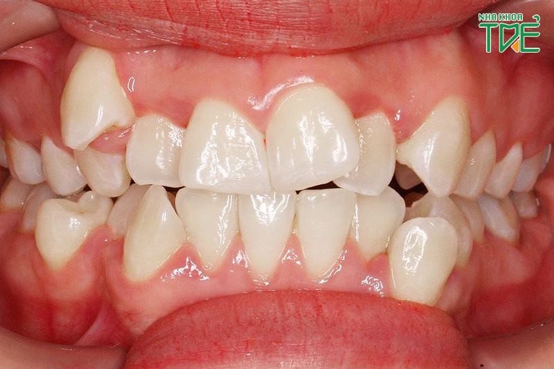 Dáng răng quỷ là hàm răng khấp khểnh, có răng nanh