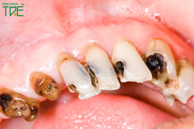 Sâu răng không điều trị triệt để có nguy hiểm đến tính mạng 