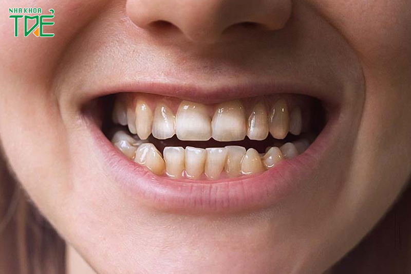 Người có men răng yếu, ngà răng mỏng có thể bị ê buốt sau tẩy trắng răng