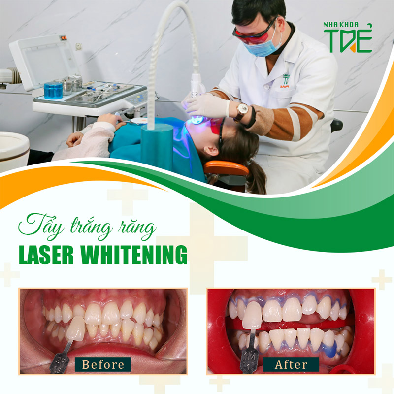 Làm trắng răng an toàn, hiệu quả nhanh chóng tại nha khoa