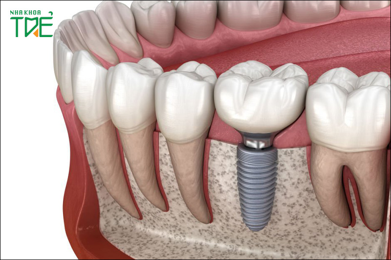Răng Implant có cấu tạo tương tự răng thật nên mang lại nhiều hiệu quả vượt trội