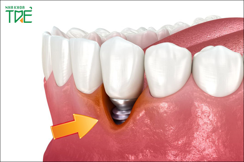 Trồng răng Implant lần 2 có được không?