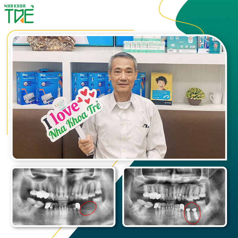 Khách hàng cấy 2 Implant cho 2 răng mất