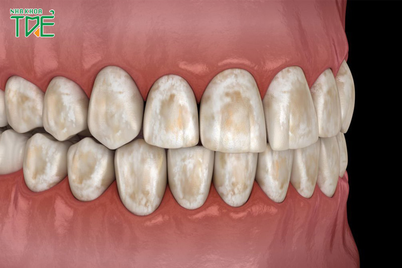 Tẩy trắng răng nhiều lần gây mòn men răng, răng dễ nhiễm fluor