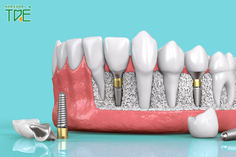 Cấy ghép Implant – Giải pháp phục hình răng toàn diện
