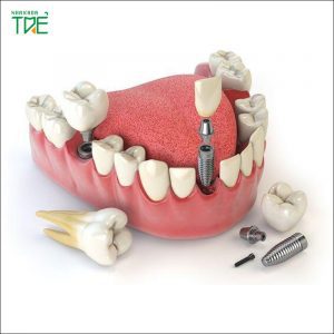 Răng Implant làm từ chất liệu gì? Đặc tính của vật liệu đó?