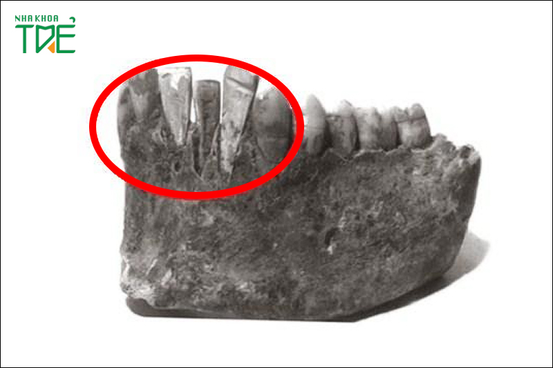Implant đã xuất hiện từ thời cổ đại