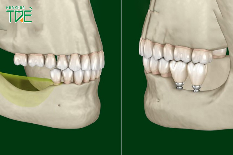 Implant được ưa chuộng bởi ưu điểm ngăn chặn tiêu xương hàm