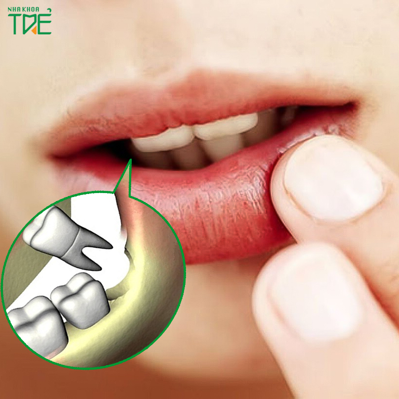 Lượng thuốc tê vẫn còn khiến bạn bị tê bì môi sau khi nhổ răng khôn