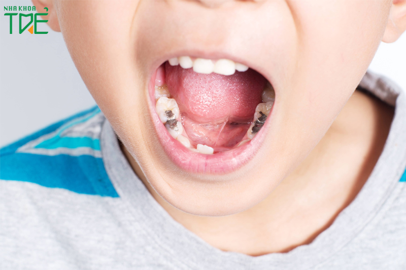 Răng trẻ em bị lung lay do sâu răng cần điều trị triệt để
