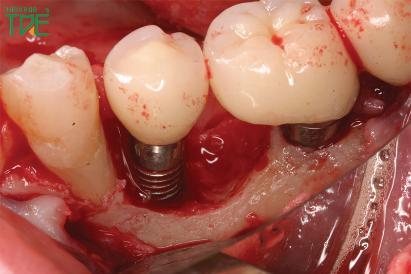 Trồng răng Implant xi măng có tỷ lệ viêm nhiễm cao hơn trồng răng Implant bắt vít