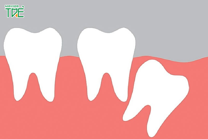 Trong các kiểu răng khôn mọc lệch, răng số 8 mọc lệch về sau vô cùng hiếm gặp