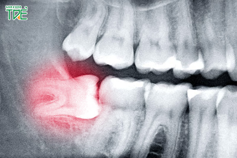 Răng khôn nằm ngang chỉ có thể phát hiện thông qua X-quang