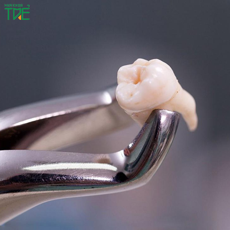 Khoảng cách giữa 2 lần nhổ răng khôn tốt nhất là bao lâu? 