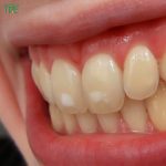 Răng có đốm trắng là bị gì? 8 cách khắc phục đốm trắng trên răng