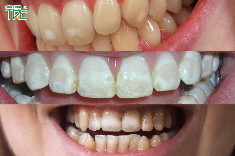 Tình trạng này sẽ làm xuất hiện những đốm trắng li ti rải rác ở trên răng