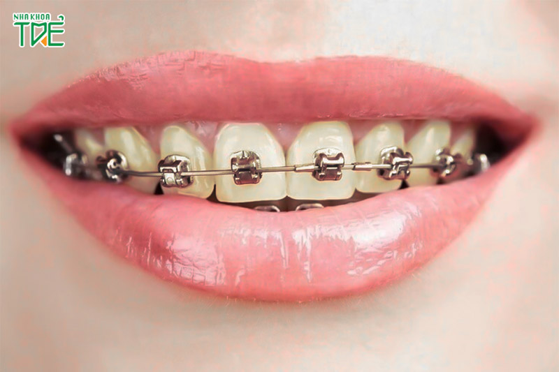 Đối tượng niềng răng có thể bị vôi hóa răng do vệ sinh khó khăn