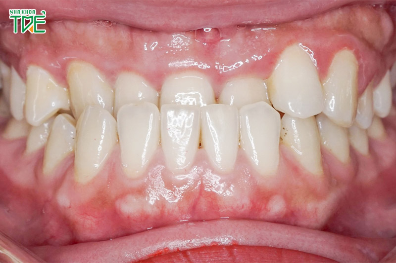Hàm răng dưới bị chìa là tình trạng “răng móm” hay “khớp cắn ngược”