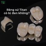 Răng sứ Titan có bị đen không? Nguyên nhân và cách giải quyết