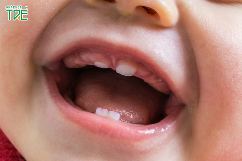 Răng sữa mọc chậm có thể ảnh hưởng quá trình mọc răng vĩnh viễn sau này