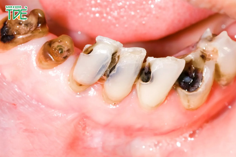 Vệ sinh răng miệng không triệt để gây sâu răng