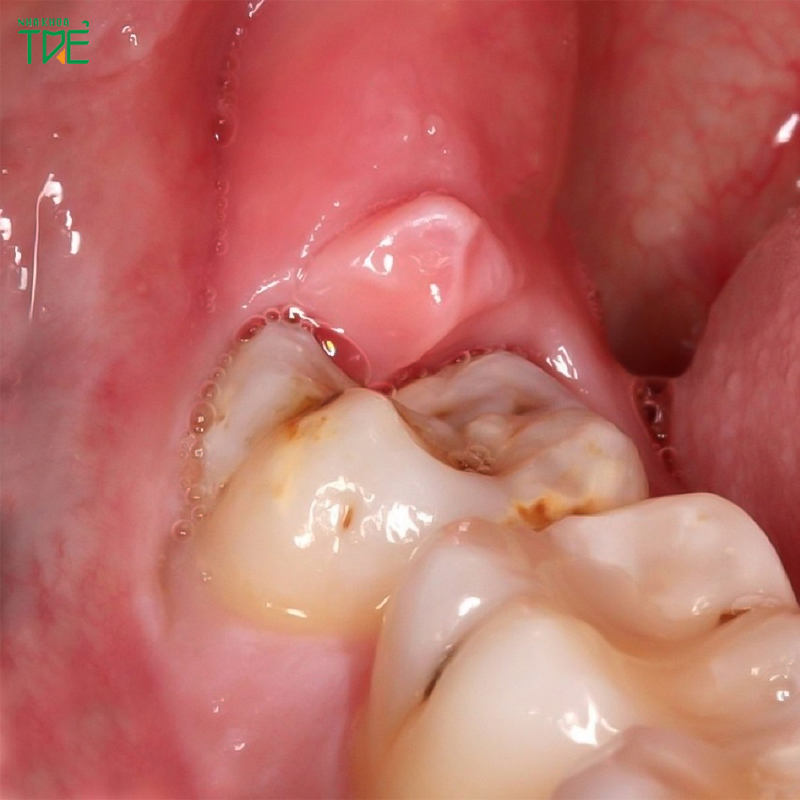 4 Cách trị sưng nướu răng trong cùng hàm trên, hàm dưới