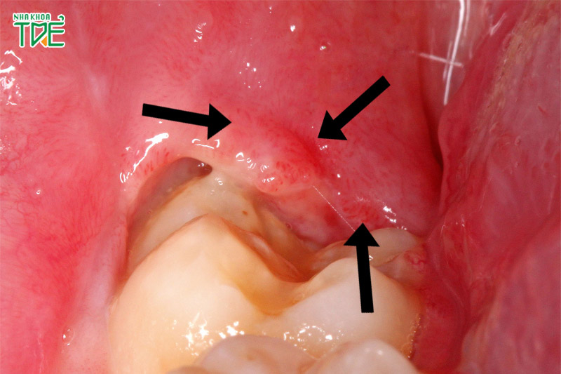 Vị trí nướu trong cùng của hàm sẽ bị sưng đỏ, thậm chí đỏ sẫm hoặc đỏ tím
