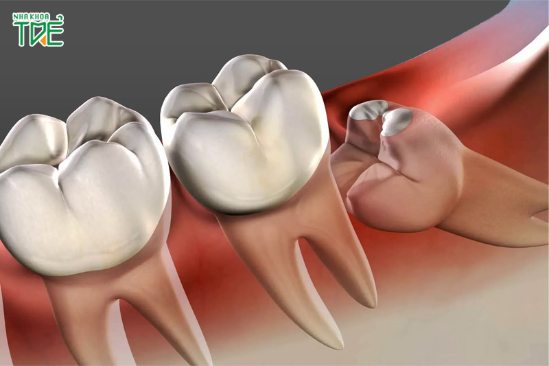 Răng khôn mọc lệch gây sưng nướu răng trong cùng hàm dưới