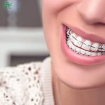 Tại sao cần cố định răng trước khi tháo niềng? Các phương pháp